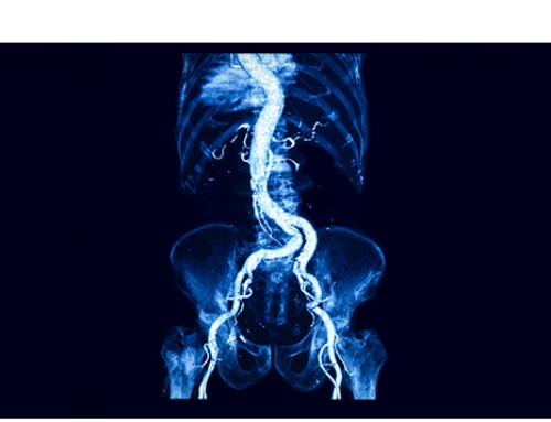 Understanding aneurysm drivers